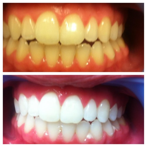 Teeth whitening strips pap - whitening,